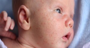 علت خالهای قرمز روی پوست نوزادان