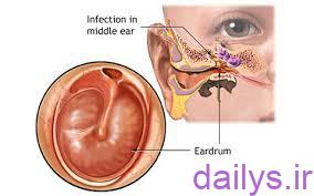 علائم عفونت گوش میانی چیست؟