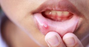 روش های درمان آفت دهان کودک