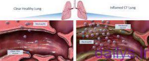 بیماری فیبروز سیستیک چیست؟