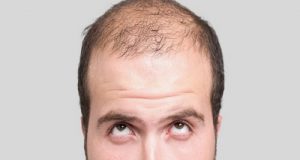 ریزش مو بعد از کاشت مو